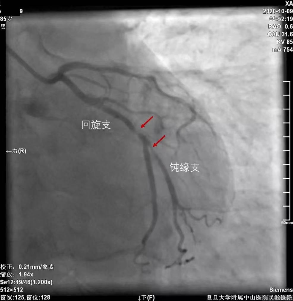 caFFR provides accurate coronary artery functional assessment to guide the precise interventional treatment at Wusong Hospital of Zhongshan Hospital, Fudan University.